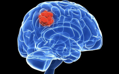 Reducing the 90% Recurrence Rate for Glioblastoma Treatment Through an Implantable Device for the Delivery of Stem Cells